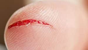 Qué Significa Soñar Con Heridas